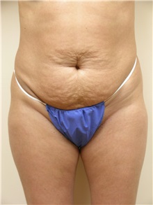 Tummy Tuck Before Photo by Michael Malczewski, MD; Hobart, IN - Case 20845