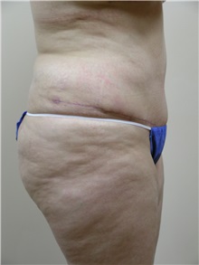 Tummy Tuck After Photo by Michael Malczewski, MD; Hobart, IN - Case 20856