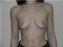 Breast Augmentation Before Photo by Michael Malczewski, MD; Hobart, IN - Case 20893