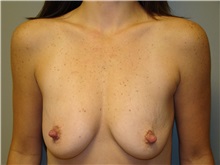 Breast Augmentation Before Photo by Michael Malczewski, MD; Hobart, IN - Case 20894