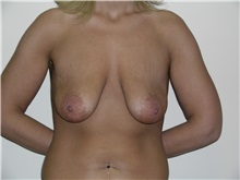 Breast Lift Before Photo by Michael Malczewski, MD; Hobart, IN - Case 20896