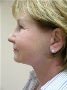 Facelift After Photo by Michael Malczewski, MD; Hobart, IN - Case 20898