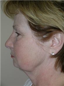 Facelift Before Photo by Michael Malczewski, MD; Hobart, IN - Case 20898