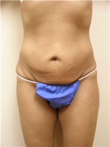 Tummy Tuck Before Photo by Michael Malczewski, MD; Hobart, IN - Case 20901