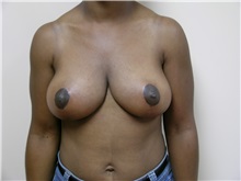 Breast Lift After Photo by Michael Malczewski, MD; Hobart, IN - Case 21003