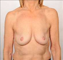 Breast Augmentation Before Photo by William Sabbagh, MD; Bingham Farms, MI - Case 24534