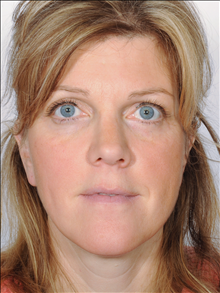 Rhinoplasty After Photo by William Sabbagh, MD; ,  - Case 24542
