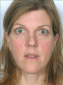 Rhinoplasty Before Photo by William Sabbagh, MD; ,  - Case 24542