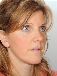 Rhinoplasty After Photo by William Sabbagh, MD; ,  - Case 24542
