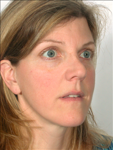 Rhinoplasty Before Photo by William Sabbagh, MD; ,  - Case 24542
