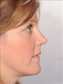 Rhinoplasty After Photo by William Sabbagh, MD; ,  - Case 24542