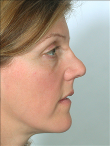 Rhinoplasty Before Photo by William Sabbagh, MD; ,  - Case 24542