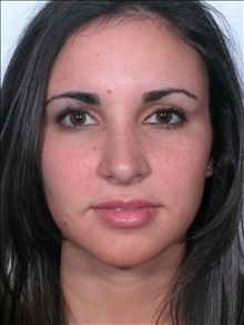 Rhinoplasty After Photo by William Sabbagh, MD; Bingham Farms, MI - Case 24545