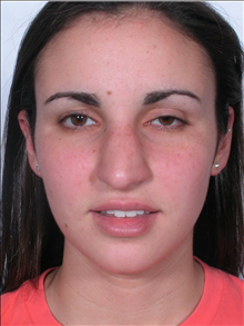 Rhinoplasty Before Photo by William Sabbagh, MD; Bingham Farms, MI - Case 24545