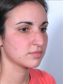 Rhinoplasty Before Photo by William Sabbagh, MD; Bingham Farms, MI - Case 24545