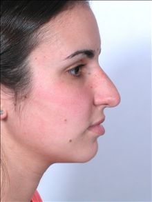 Rhinoplasty Before Photo by William Sabbagh, MD; Bingham Farms, MI - Case 24545