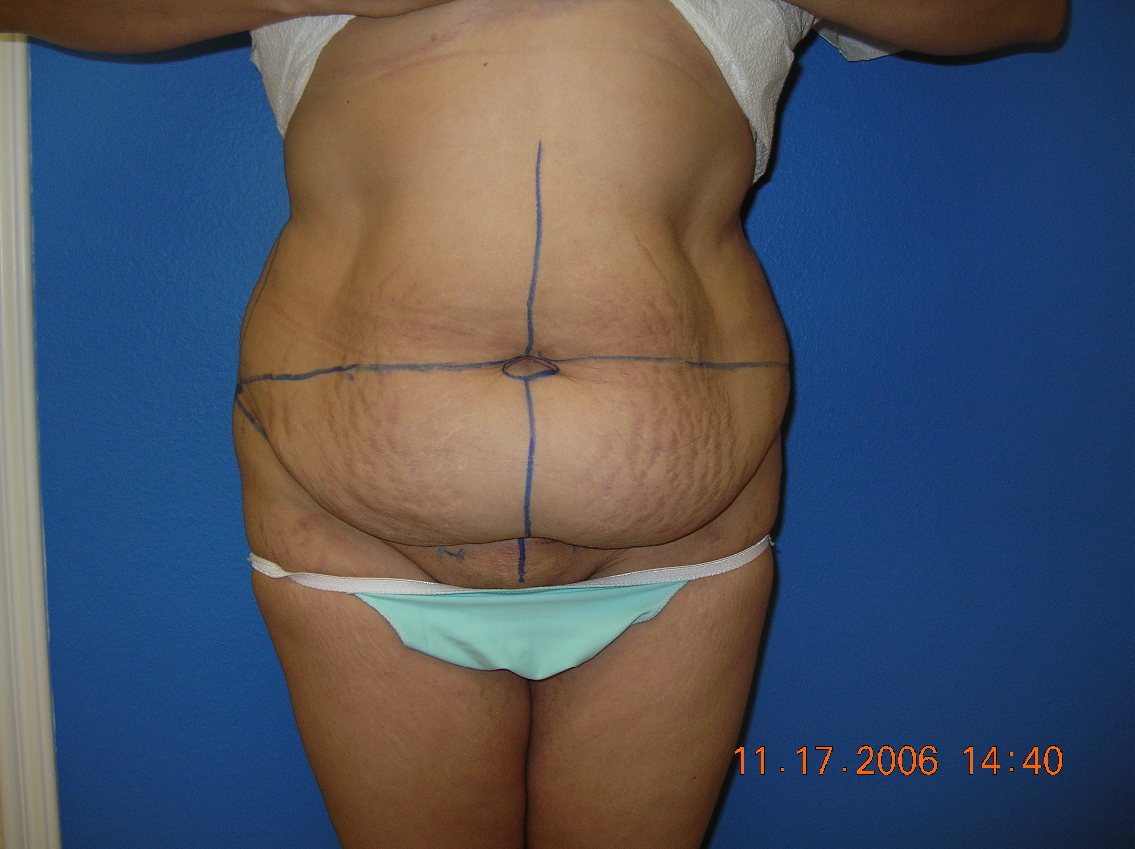 Tummy Tuck Before and After Photos by Jon Paul Trevisani, MD, FACS;  Maitland, FL - Case 8955