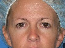 Eyelid Surgery Before Photo by Jon Paul Trevisani, MD, FACS; Maitland, FL - Case 8991