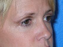 Eyelid Surgery After Photo by Jon Paul Trevisani, MD, FACS; Maitland, FL - Case 8991