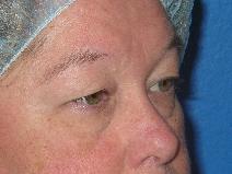 Eyelid Surgery Before Photo by Jon Paul Trevisani, MD, FACS; Maitland, FL - Case 8993