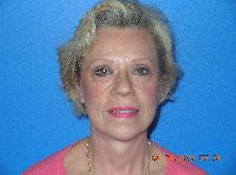 Facelift After Photo by Jon Paul Trevisani, MD, FACS; Maitland, FL - Case 8997