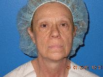 Facelift Before Photo by Jon Paul Trevisani, MD, FACS; Maitland, FL - Case 8997