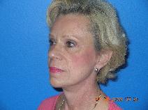Facelift After Photo by Jon Paul Trevisani, MD, FACS; Maitland, FL - Case 8997