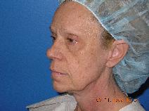 Facelift Before Photo by Jon Paul Trevisani, MD, FACS; Maitland, FL - Case 8997