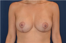 Breast Lift After Photo by Brian Hass, MD; Palm Beach Gardens, FL - Case 43002