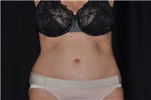 Tummy Tuck After Photo by Brian Hass, MD; Palm Beach Gardens, FL - Case 43003