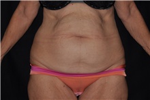 Tummy Tuck Before Photo by Brian Hass, MD; Palm Beach Gardens, FL - Case 43003