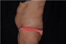 Tummy Tuck Before Photo by Brian Hass, MD; Palm Beach Gardens, FL - Case 43003
