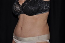 Tummy Tuck After Photo by Brian Hass, MD; Palm Beach Gardens, FL - Case 43003