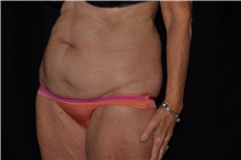 Tummy Tuck Before Photo by Brian Hass, MD; Palm Beach Gardens, FL - Case 43003