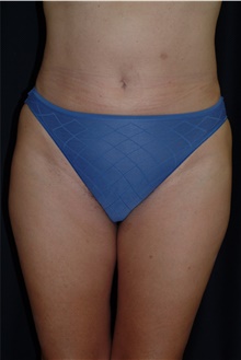 Liposuction After Photo by Brian Hass, MD; Palm Beach Gardens, FL - Case 43004