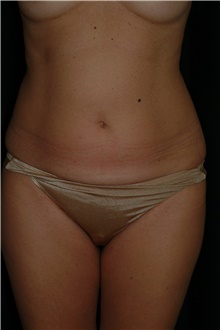 Liposuction Before Photo by Brian Hass, MD; Palm Beach Gardens, FL - Case 43004