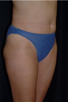 Liposuction After Photo by Brian Hass, MD; Palm Beach Gardens, FL - Case 43004