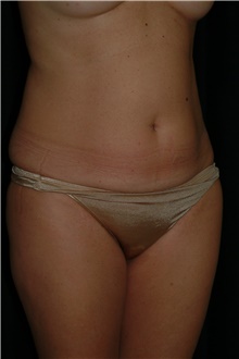 Liposuction Before Photo by Brian Hass, MD; Palm Beach Gardens, FL - Case 43004