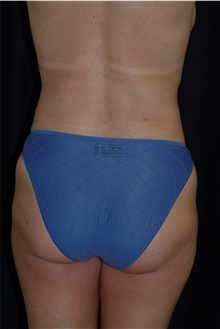 Liposuction After Photo by Brian Hass, MD; Palm Beach Gardens, FL - Case 43004