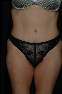 Tummy Tuck After Photo by Brian Hass, MD; Palm Beach Gardens, FL - Case 43005