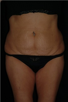 Tummy Tuck Before Photo by Brian Hass, MD; Palm Beach Gardens, FL - Case 43005