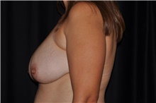 Breast Lift Before Photo by Brian Hass, MD; Palm Beach Gardens, FL - Case 43006