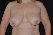 Breast Lift Before Photo by Brian Hass, MD; Palm Beach Gardens, FL - Case 43007