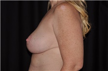 Breast Lift After Photo by Brian Hass, MD; Palm Beach Gardens, FL - Case 43007