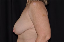 Breast Lift Before Photo by Brian Hass, MD; Palm Beach Gardens, FL - Case 43007