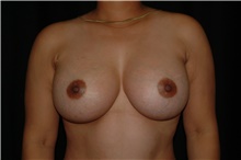 Breast Augmentation After Photo by Brian Hass, MD; Palm Beach Gardens, FL - Case 43008