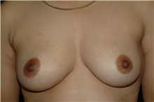 Breast Augmentation Before Photo by Brian Hass, MD; Palm Beach Gardens, FL - Case 43008