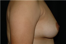 Breast Augmentation Before Photo by Brian Hass, MD; Palm Beach Gardens, FL - Case 43008