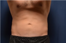 Nonsurgical Fat Reduction After Photo by Brian Hass, MD; Palm Beach Gardens, FL - Case 43011