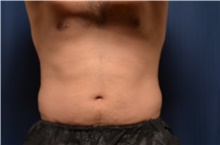 Nonsurgical Fat Reduction Before Photo by Brian Hass, MD; Palm Beach Gardens, FL - Case 43011